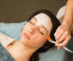 Acne Facial